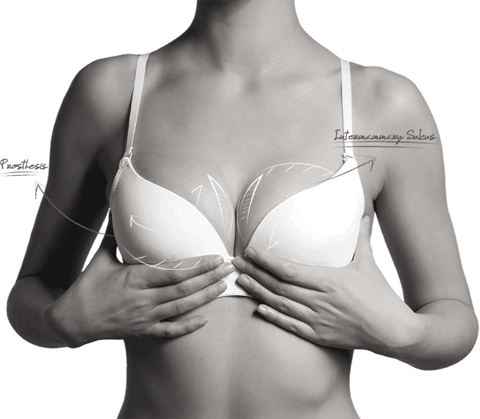 U&U內衣穿著教學——隆乳術後內衣穿著說明
