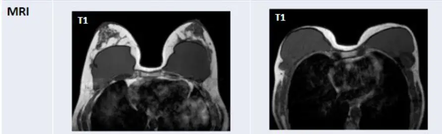 義乳破裂,一定要照 MRI 嗎?用超音波不能檢查嗎 — 內文圖片 6