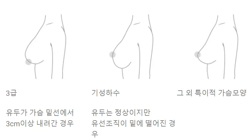 乳房提乳手術費用？先查價格其實沒什麼意義。 — 內文圖片 4