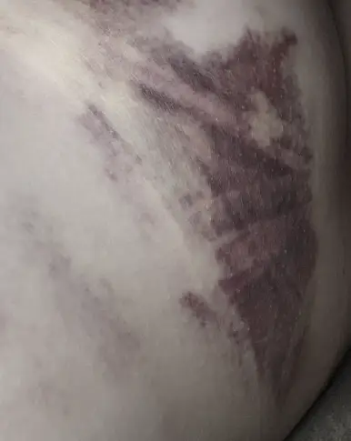 乳房手術的恢復,可能讓它延後超過 1 週的 2 種併發症,來自 20 年研究的建議 — 內文圖片 6