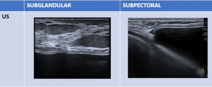 義乳破裂,一定要照 MRI 嗎?用超音波不能檢查嗎 — 內文圖片 5