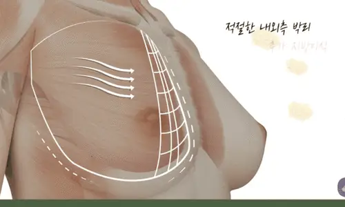 雞胸手術,隆乳後會不會只變大,卻沒有乳溝?<根據20年研究經驗提供的建議> — 內文圖片 4