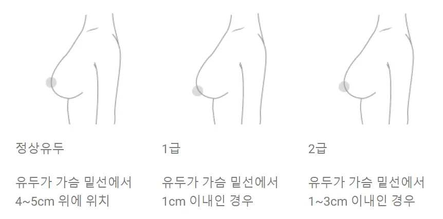 乳房提乳手術費用？先查價格其實沒什麼意義。 — 內文圖片 3