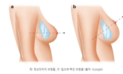 義乳下移重修手術?腋下切口/乳房下緣切口方式總整理 <根據20年研究經驗提供的建議> — 內文圖片 4