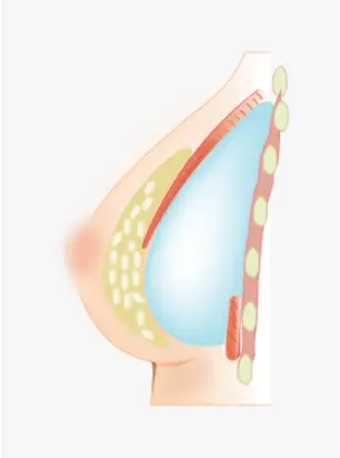 平胸隆乳，義乳會不會太明顯？〈以實際研究為依據的建議〉 — 內文圖片 5