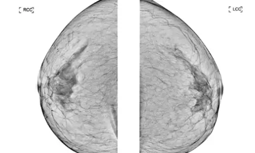 乳房手術與哺乳？隆乳、縮乳、提乳，各術式完整整理〈來自設有乳房外科專科醫師的診所的建議〉 — 內文圖片 11