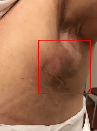 乳房手術的恢復,可能讓它延後超過 1 週的 2 種併發症,來自 20 年研究的建議 — 內文圖片 7