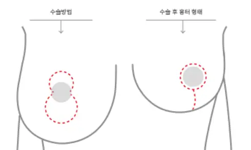 乳房下垂手術費用,以及需要提乳/義乳的情況也為您整理說明。<根據20年研究經驗提供的建議> — 內文圖片 5