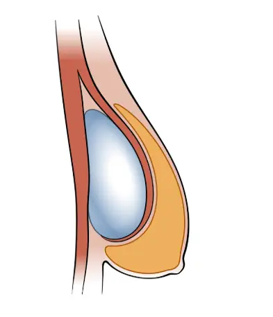 產後乳房下垂，以為只用義乳把上胸填滿就夠了？這是個誤解。 — 內文圖片 5