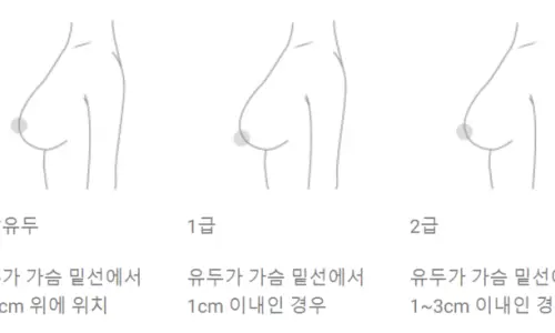 乳房下垂手術的評價？別被誤導了。 — 內文圖片 12