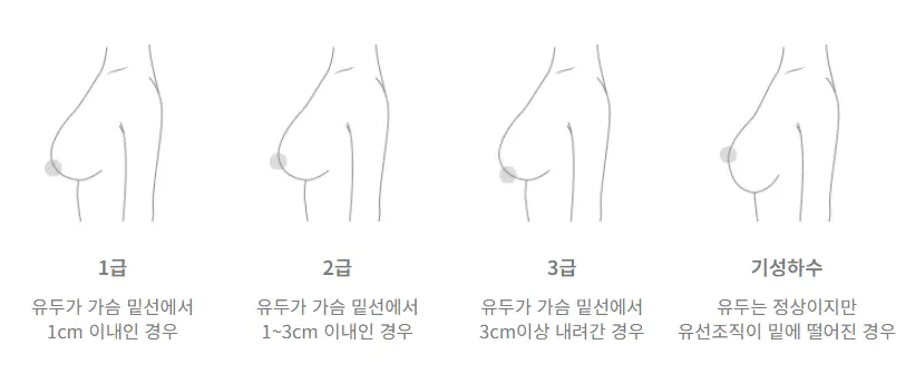 產後乳房下垂，以為只用義乳把上胸填滿就夠了？這是個誤解。 — 內文圖片 6
