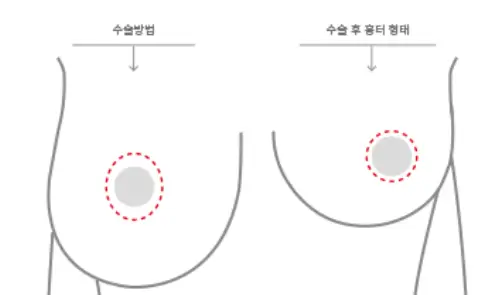 乳房下垂手術費用,以及需要提乳/義乳的情況也為您整理說明。<根據20年研究經驗提供的建議> — 內文圖片 6