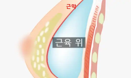隆乳觸感會因疤痕而改變嗎?分享論文證實的事實。 — 內文圖片 8