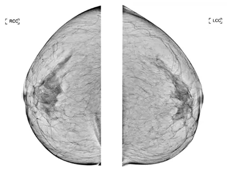 隆乳後哺乳,會有問題嗎?等到哺乳結束時,會不會因義乳重量而更加下垂? — 內文圖片 9