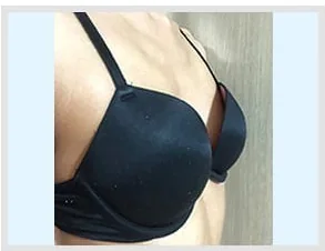 隆乳術前側面照 3
