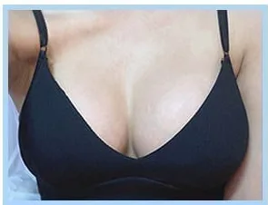 隆乳術後3週照片 4