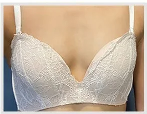 隆乳術前照片 4