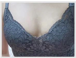 隆乳術前照片 5