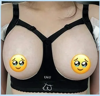 隆乳術後第2天穿著塑身內衣的正面照 2