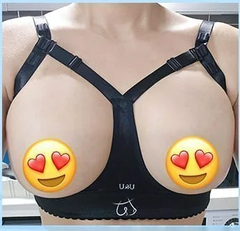 隆乳術後第2天穿著塑身內衣的正面照 6