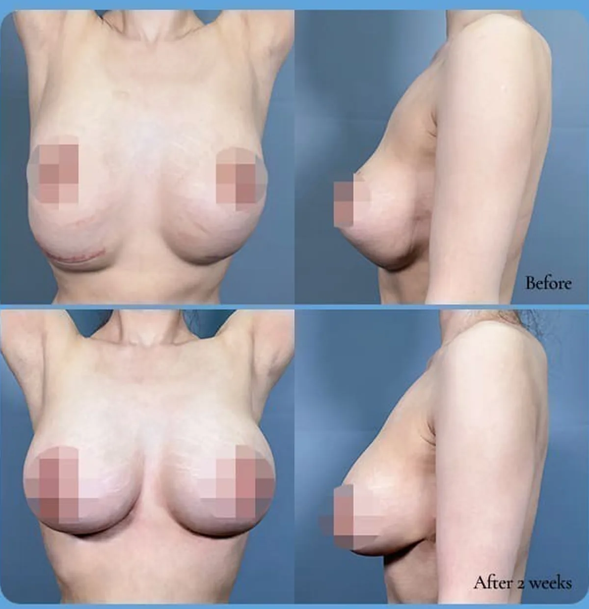 義乳下移修復手術術前術後對照照片——Before/After 2 weeks(正面·側面)