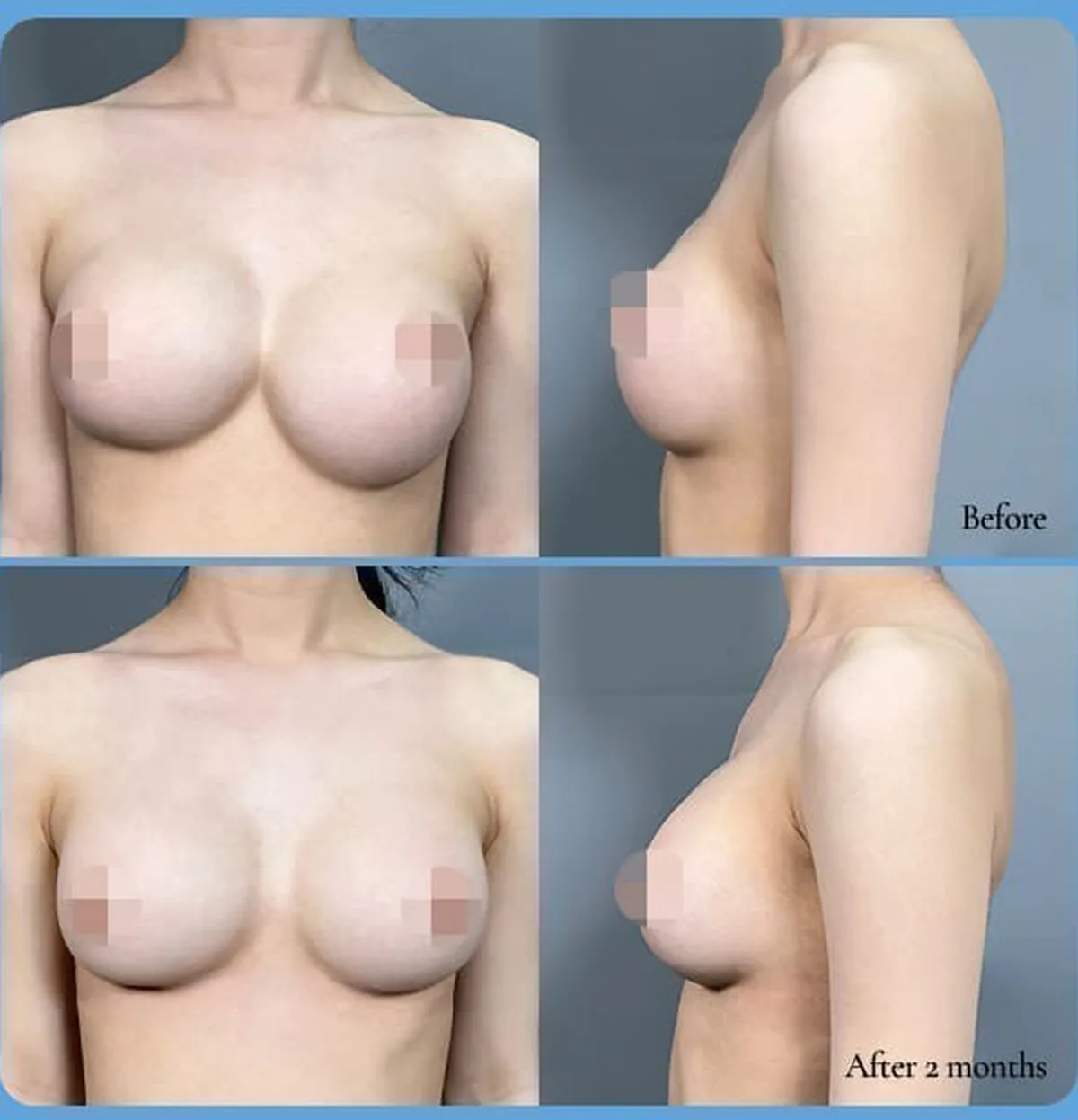 義乳前移(連通乳)·義乳下移修復手術術前術後對照照片——Before/After 2 months(正面·側面)