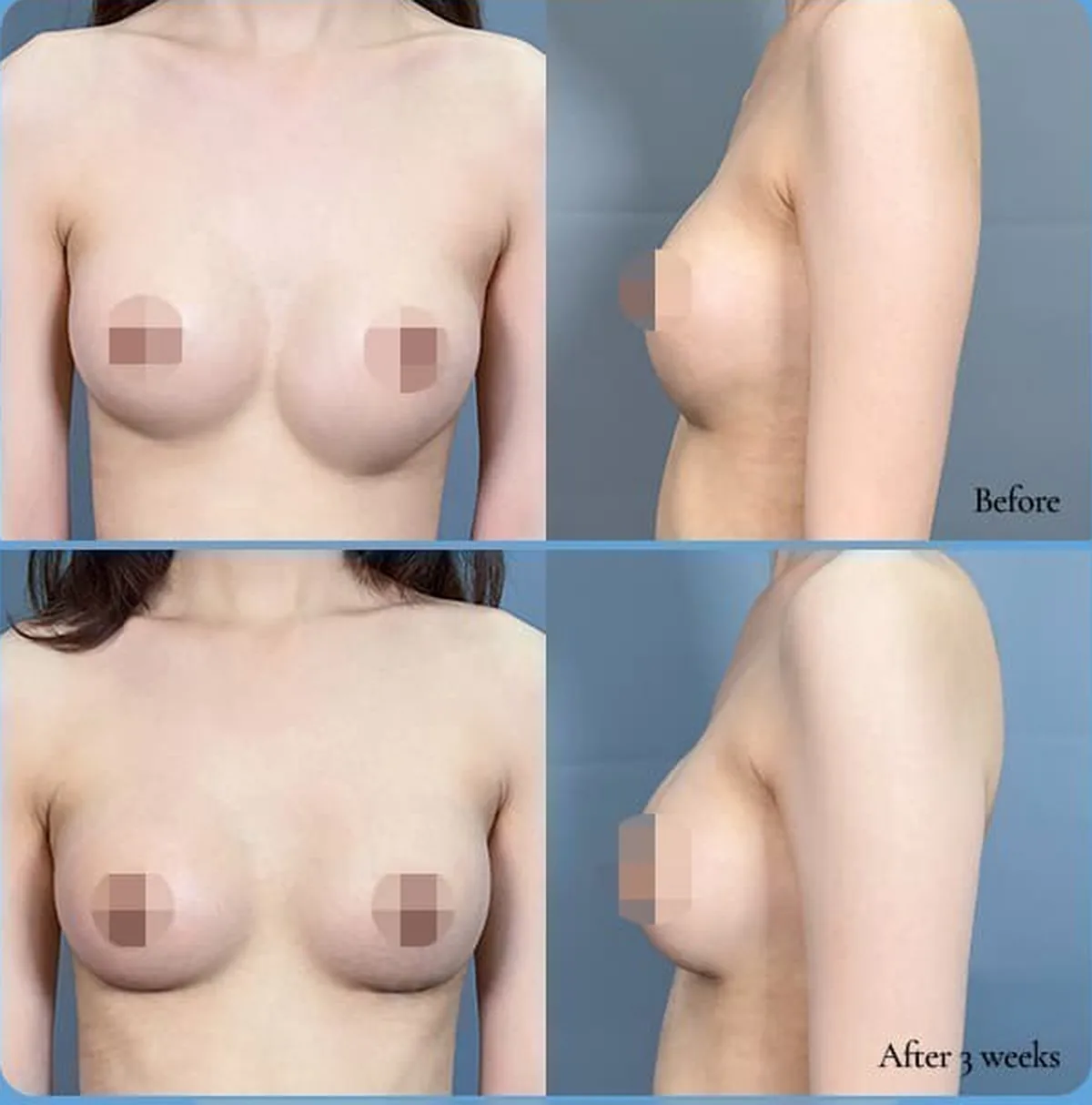 義乳下移造成左右不對稱的修復手術術前術後對照照片——Before/After 3 weeks(正面·側面)