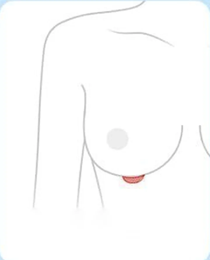 標示乳房下緣切口位置的示意圖