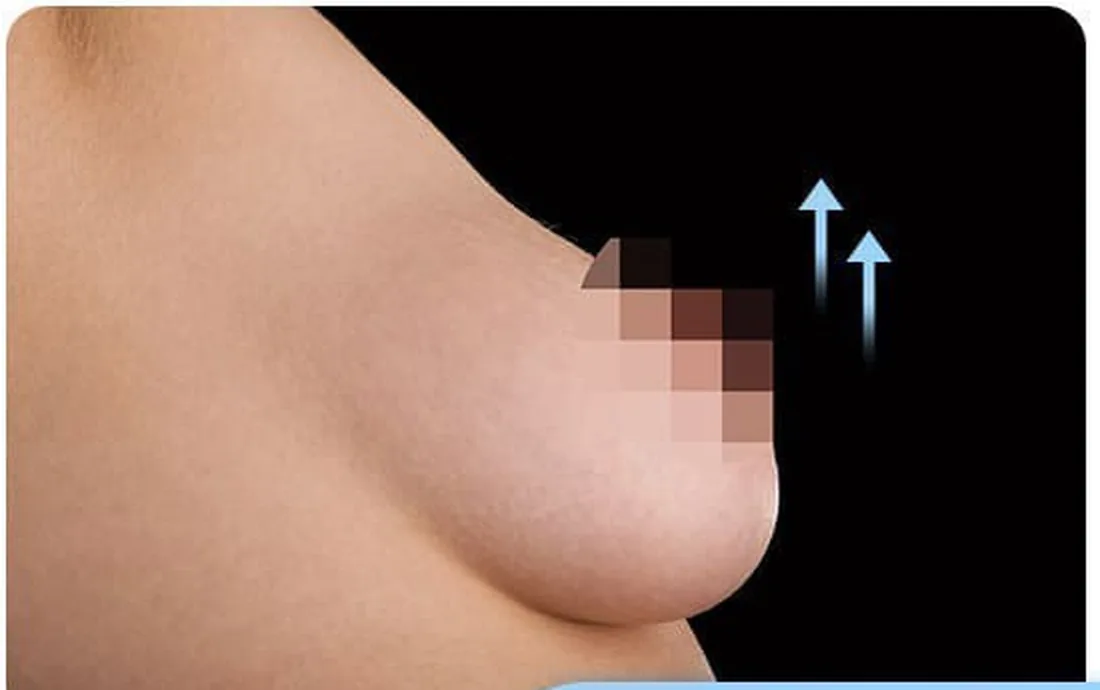 義乳下移的乳房側面——乳房下緣向下位移