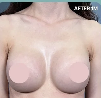 改善乳溝療程1個月後的正面照