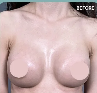 改善乳溝療程前的正面照