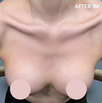 改善波紋感療程1個月後的乳房上方照片