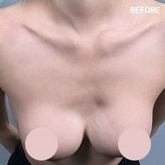 改善波紋感療程前的乳房上方照片