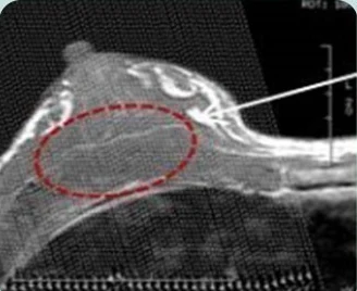 乳房側面CT影像—標示注射部位的圖片