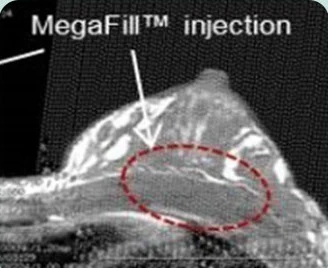 MegaFill™ injection—標示乳房側面CT影像植入部位的圖片