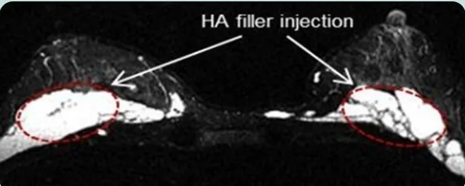 HA filler injection—標示雙側乳房MRI軸向影像填充劑注射部位的圖片