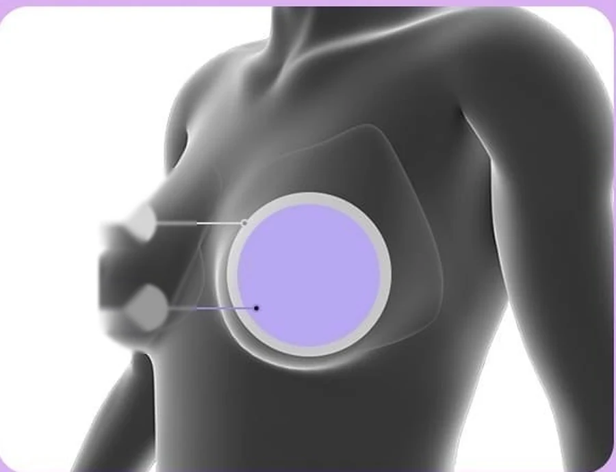 乳房剖面示意圖—剝離至乳房肌肉下方的義乳腔袋,以及置於其中的圓形義乳
