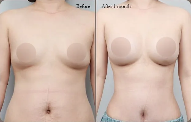 乳房腹部同步拉提術前與術後1個月正面對照照片1