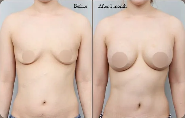 乳房腹部同步拉提術前與術後1個月正面對照照片2
