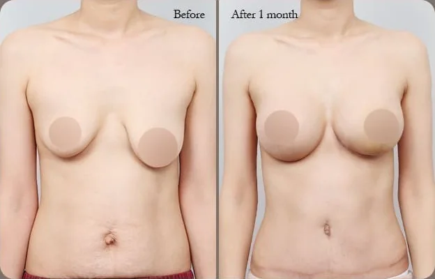 乳房腹部同步拉提術前與術後1個月正面對照照片3