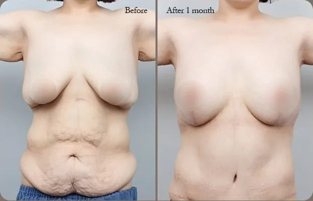 乳房腹部同步拉提術前與術後1個月正面對照照片4