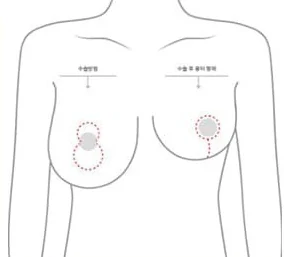標示垂直切口位置與術後疤痕外型的上半身示意圖