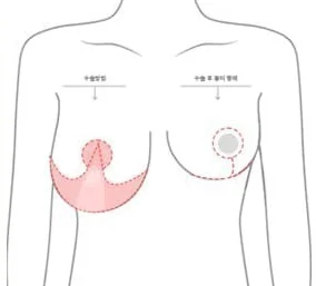 標示倒T型切口範圍與術後疤痕外型的上半身示意圖