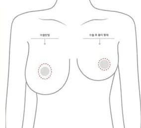 標示乳暈切口位置與術後疤痕外型的上半身示意圖