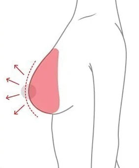 僅植入義乳增加份量的隆乳側面示意圖