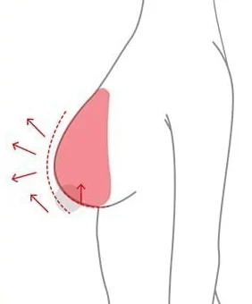 植入義乳並上提乳頭位置的提乳側面示意圖