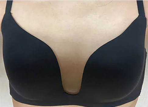 隆乳術前照片 7