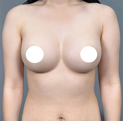 隆乳術後1