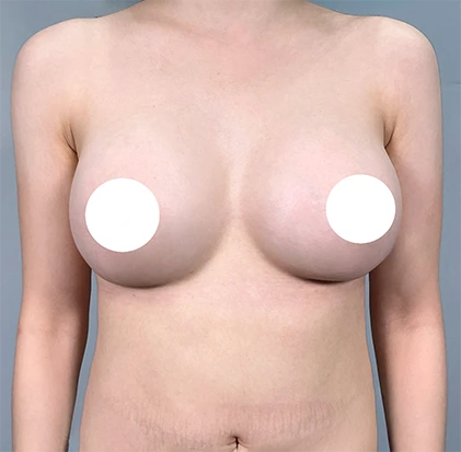 隆乳術後3