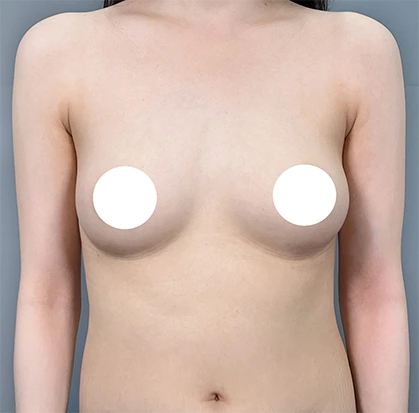 隆乳術前3
